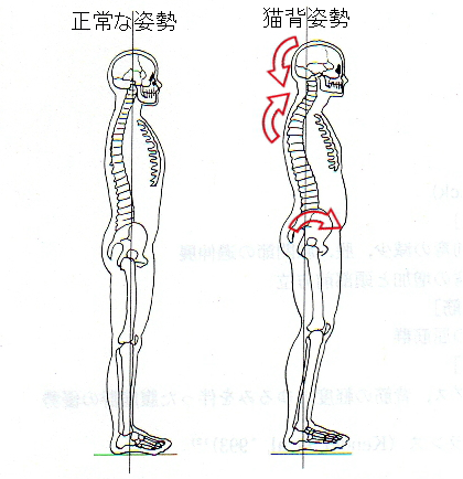 正しい姿勢と猫背姿勢の比較図