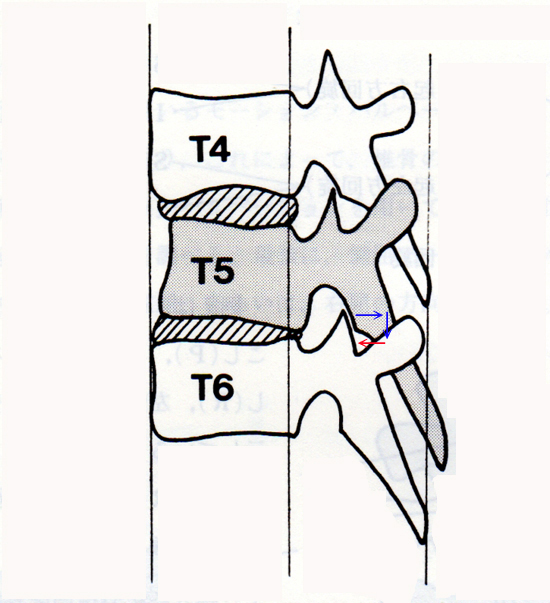 胸椎5番が後方・下方にズレた図