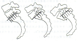 腰椎分離すべり症の模式図